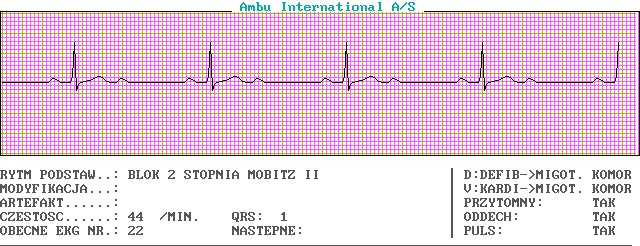 EKG wykresy z łyżek, Pierwsza Pomoc - c22-0.png