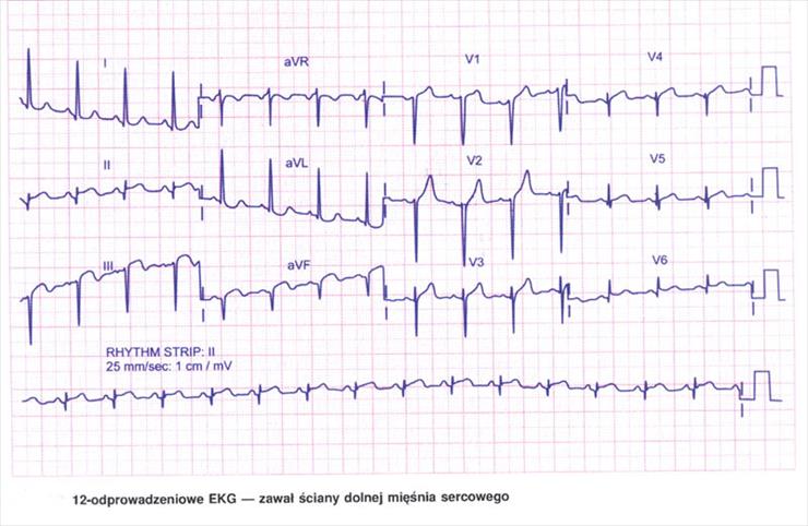 EKG - zawal sciany dolnej miesnia sercowego.jpg
