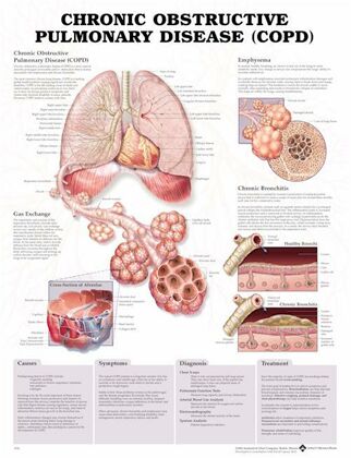 plansze anatomiczne chorób człowieka - Plansze anatomiczne choroba-obturacyjna.jpg